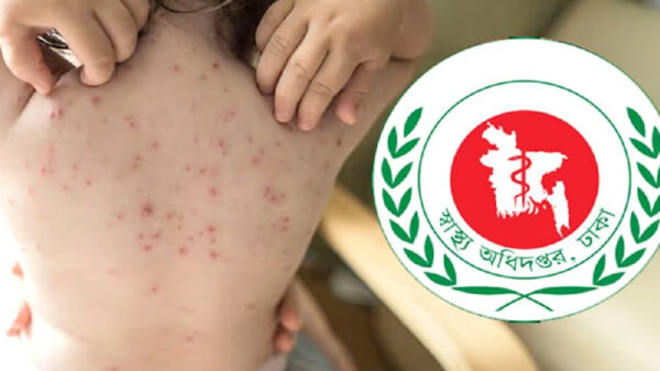 হামের প্রাদুর্ভাব উদ্বেগজনক ॥ উপসর্গ নিয়ে আরও ১০ শিশুর মৃত্যু